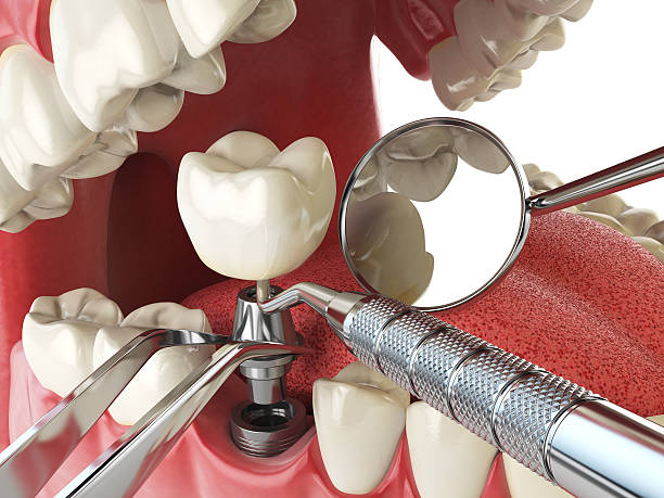 Best Emergency Treatment for Dental Infections or Abscesses in Lake Sarasota, FL